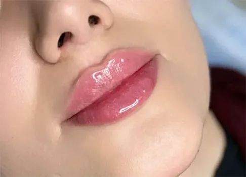 تاثیر فیلر لب بر زیبایی صورت